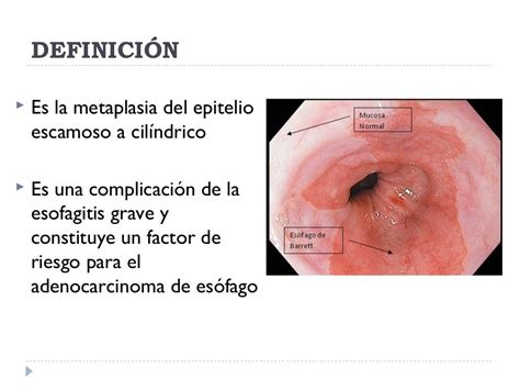 Esofago De Barret