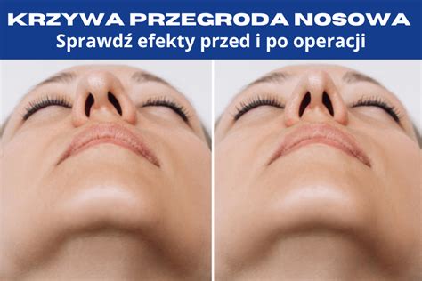 Czy mam krzywą przegrodę nosową Kiedy zdecydować się na operację