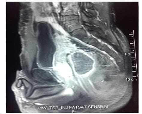 Image Showing Sagittal View Of A T2 Weighted Magnetic Resonance Image Download Scientific