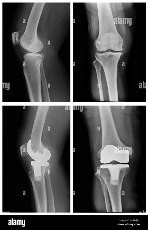 Radiografia Del Ginocchio Sostitutivo Foto E Immagini Stock In Bianco E