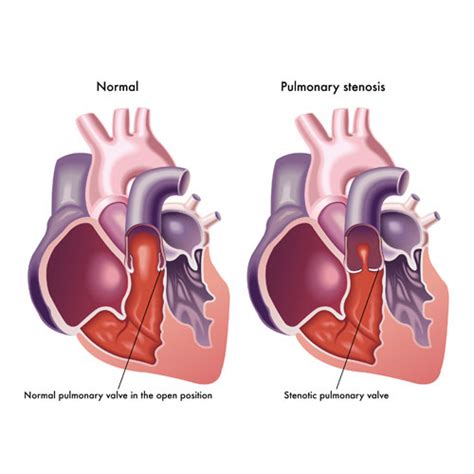 Pulmonary Valve