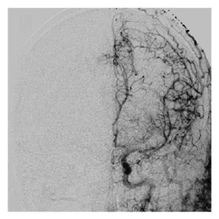 Cerebral Angiogram In A AP And B Lateral Common Carotid Injections