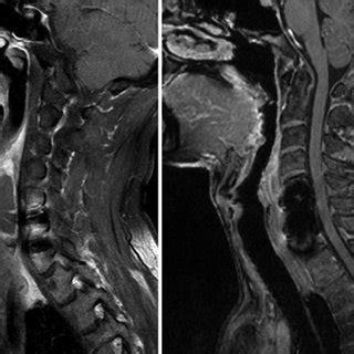 Case Postoperative Sagittal Ct A T Weighted Mr B And Stir C