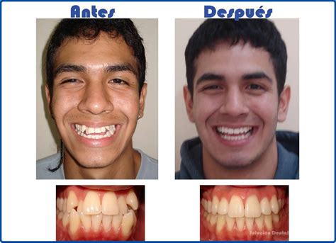 Fotos Antes Despu S Soluci N Dental