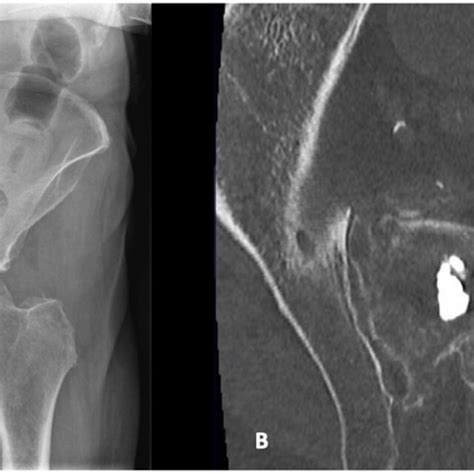 A Anteroposterior Pelvic Radiograph Showing Bilateral Sacroplasty B