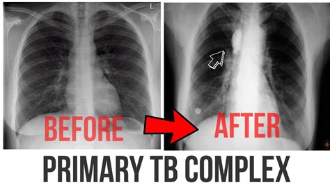 Tb Primary Complex On Chest X Ray Youtube