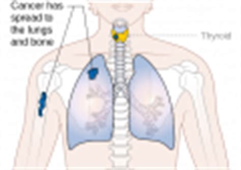 Medullary thyroid cancer staging - wikidoc