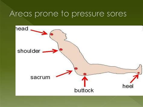 Ppt Decubitis Ulcer Pressure Bed Sore Powerpoint Presentation Id 5832209