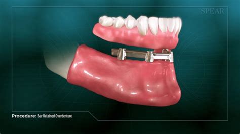 Patient Education Video on Bar-Retained Overdentures - Spear Education