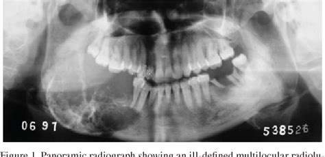 Figure 1 From Ameloblastic Fibro Odontosarcoma Of The Mandible With