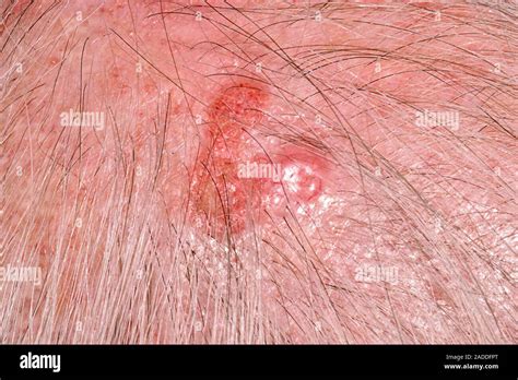 Nodular Basal Cell Carcinoma On The Scalp Of An Year Old Man Basal