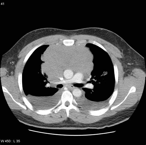 Mediastinal Lymphoma Large B Cell Image