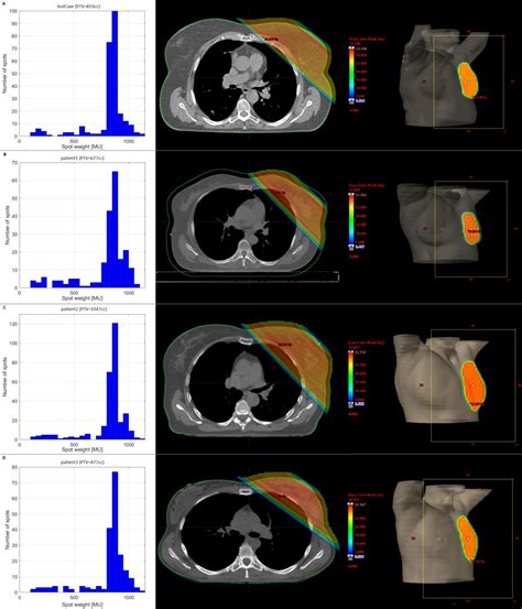 [pdf] Single Ultra High Dose Rate Proton Transmission Beam For Whole Breast Flash Irradiation