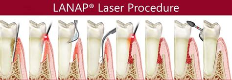 LANAP Procedure In Los Angeles LANAP Procedure Near You 90025