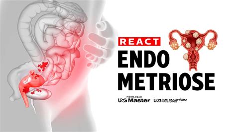 Desvendando A Endometriose Ultrassonografia Profunda E Prepara O