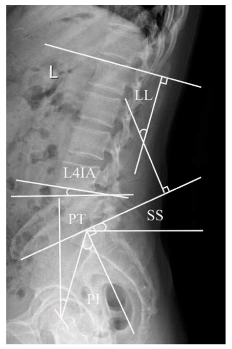 Jpm Free Full Text Analysis Of Degenerative And Isthmic Lumbar