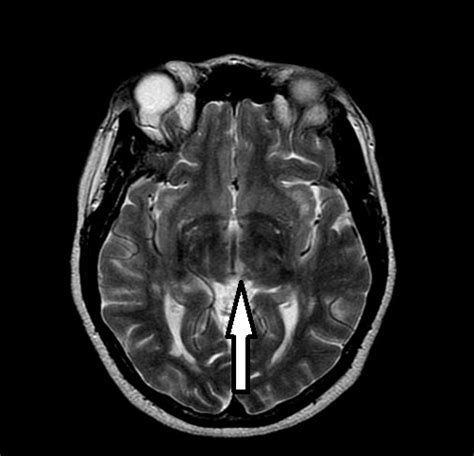 Unilateral Thalamic Infarction Presenting As Vertical Gaze Palsy A