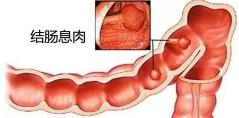 患上「腸息肉」的人，上廁所會出現這三個現象！希望你一個都沒有 每日頭條