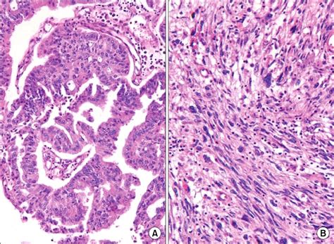 Histopathologic Finding Of Uterus Malignant Mixed Müllerian Tumor Download Scientific Diagram