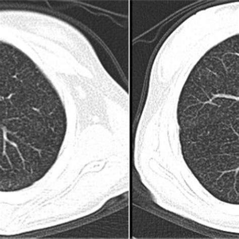 Representative Slices Of Chest Ct Images Showed Diffuse Miliary Nodules