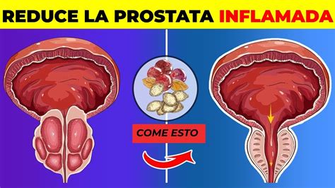 7 formas de REDUCIR la próstata agrandada de forma natural YouTube