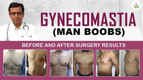 Gynecomastia Man Boobs Before And After Surgery Results Photos Care