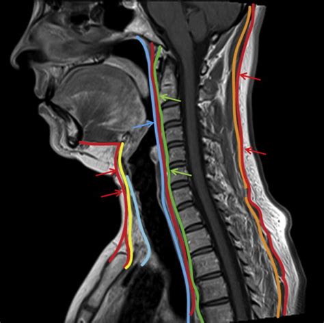 Imaging Anatomy Of Deep Neck Spaces Ento Key