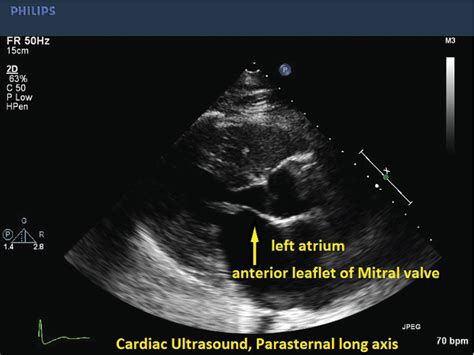 Pdf Mitral Stenosis A Review Semantic Scholar