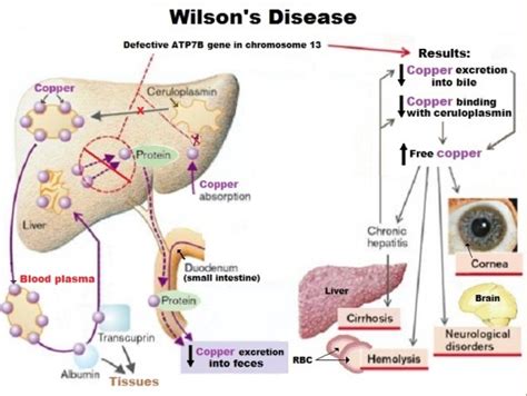 Wilson Disease, Causes, Investigations | Homeopathic Treatment