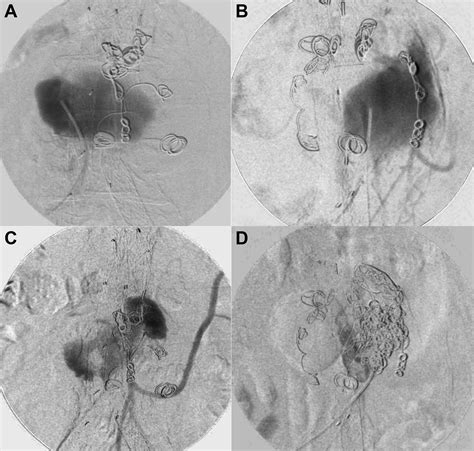 The Roadside Technique For Type Ii Endoleak Embolization 4 Years After