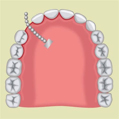 (PDF) Flap Techniques in Dentoalveolar Surgery