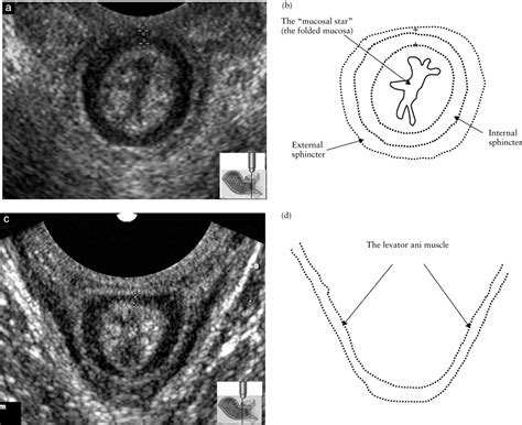 Simple Ultrasound Evaluation Of The Anal Sphincter In Female Patients Using A Transvaginal