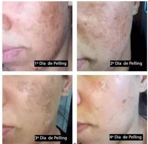 Clareador Virilha Cido Retinoico Peeling D Tca Brinde Venda Em