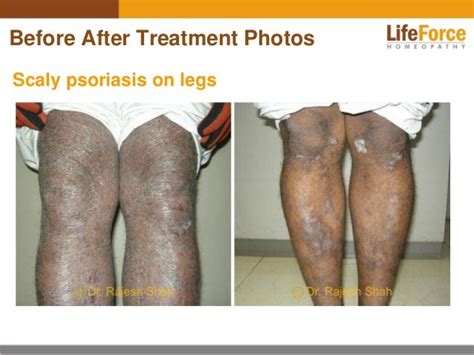 Psoriasis On Legs Photos Before After Treatment Pictures Of Patients