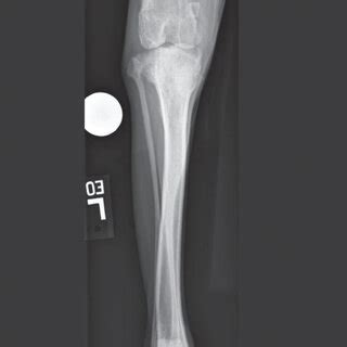 A B C D Radiographs Of Both Crura At The Time Of Presentation