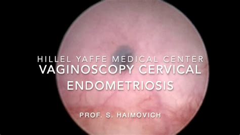 Cervical Endometriosis Youtube