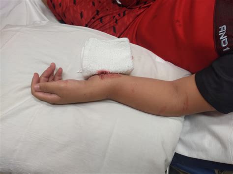 What Is A Compound Fracture Clearance Outlet | brunofuga.adv.br