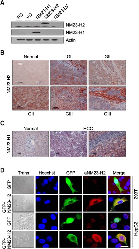 Nm23 H2 Over Expression In Hcc A Specific Immunoreactivity Of