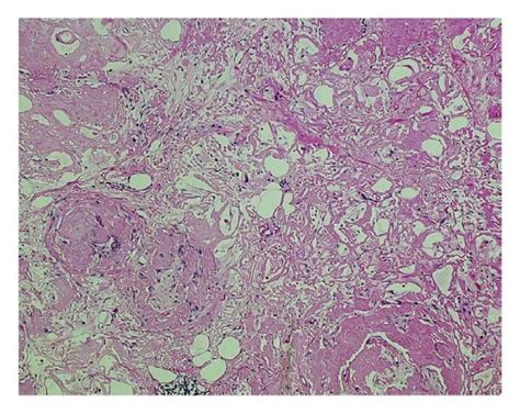 Biopsy Of The Mesenteric Lesion Showing Poor Cellular Components And