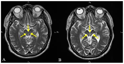 Hummingbird Sign Mri