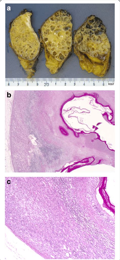 Ac Macroscopic And Microscopic Aspects Of The Resected Specimen