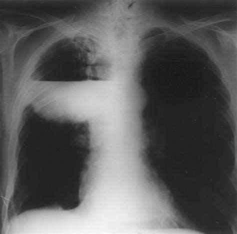 Chest Radiography Revealing Abscess Formation Download Scientific