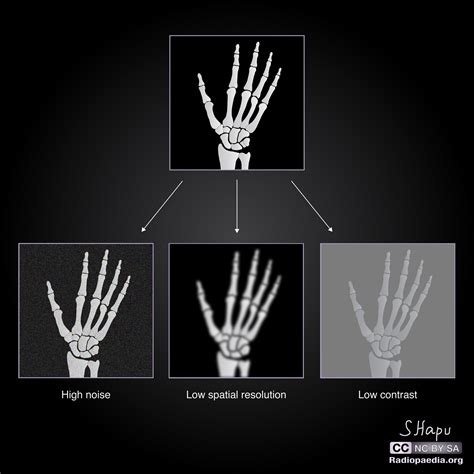 Radiographic Image Quality Diagrams Image Radiopaedia Org