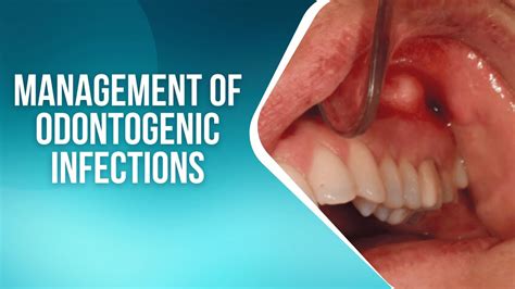 Management Of Odontogenic Infections 6 Effective Treatments Youtube