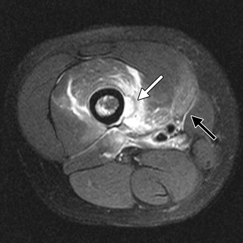 Hematogenous Osteomyelitis In Infants And Children Imaging Of A