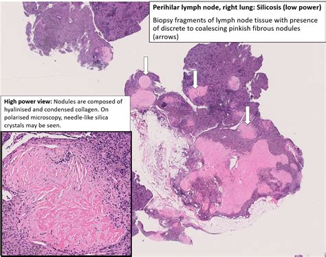 Silicosis Lymph Node Histology - Rodney Henry Viral