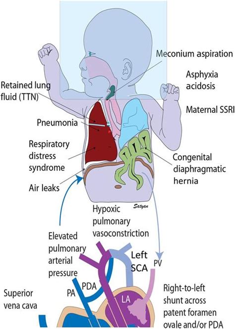 Persistent Pulmonary Hypertension Of The Newborn Neoreviews