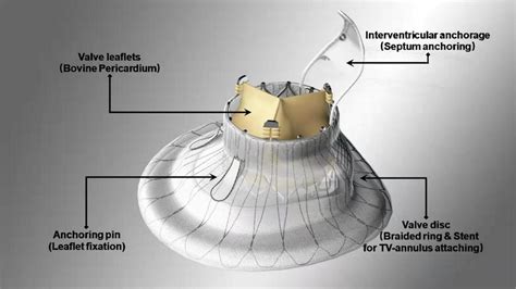 The Lux Valve The Lux Valve Has 4 Components 1 A Bovine Pericardium Download Scientific