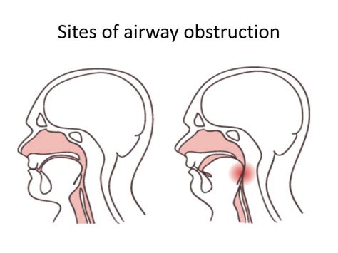 Ppt Applied Anatomy Of Airway Powerpoint Presentation Id2976616