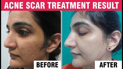 Acne Scar Specialist Dermatologist Best Scar Treatment Results